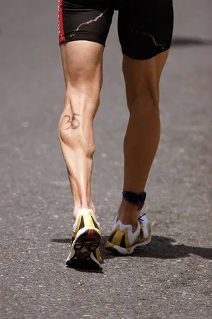Op. Dr. Halil Buldu: a photo of an Achilles tendon rupture as seen from the back of the leg.