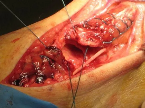 An image from an Achilles tendon rupture operation performed by Op. Dr. Halil Buldu.