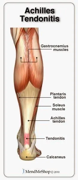 A scientific illustration by Op. Dr. Halil Buldu explaining in detail what an Achilles rupture is.