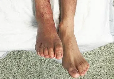 Leg lengthening surgery