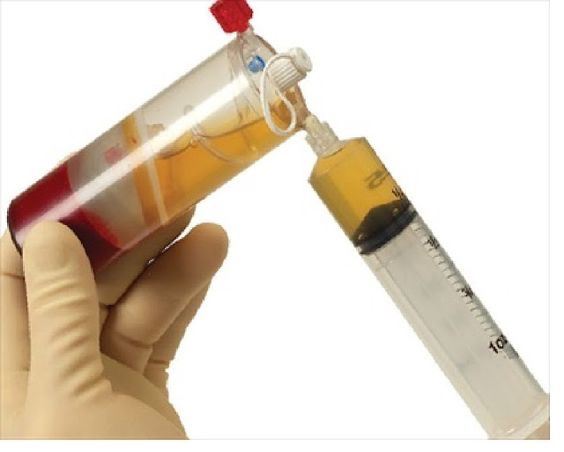 PRP Uygulamasının, Tüpten aşıya geçerken ki fotoğrafı - Opr. Dr. Halil Buldu
