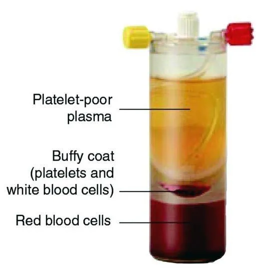 A tube showing platelet-poor plasma, the buffy coat and red blood cells. Op. Dr. Halil Buldu