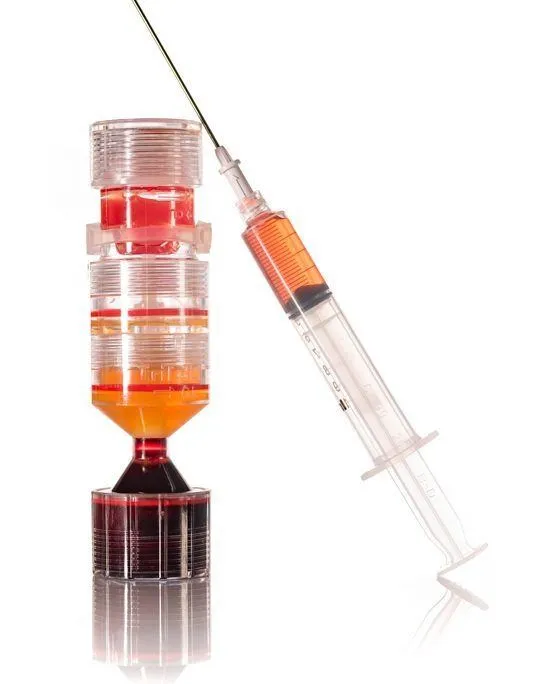 A PRP injection and the PRP itself shown in one photograph. Op. Dr. Halil Buldu