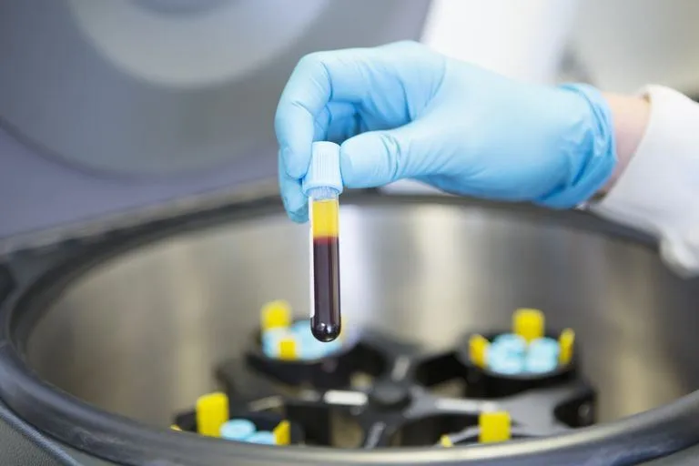 Photograph of the PRP preparation after centrifugation. Op. Dr. Halil Buldu