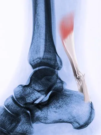 MRI image of the ankle showing the Achilles tendon - Op. Dr. Halil Buldu.