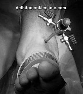 Ayak Bileği kireçlenmesinde bir cihaz kullanılarak yapılan methodun bir insan bedeninde uygulandığı bir görsel. - Opr. Dr. Halil Buldu