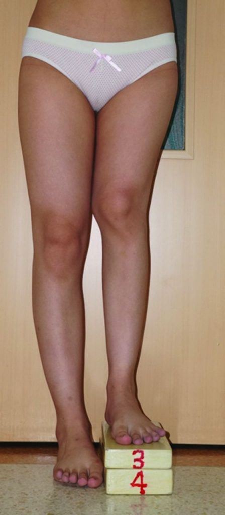 Bir bacak boy eşitsizliği durumunu anlatan resim. Resimde bir bacak kısa bir bacak uzun şekilde gözüküyor. Opr. Dr. Halil Buldu