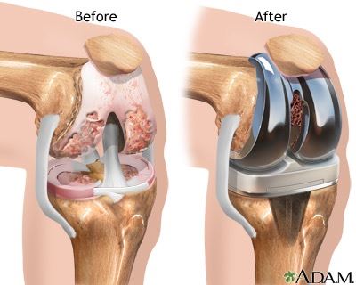 Diz protezi öncesi ve sonrası durumu analtan bilimsel bir görsel. Opr. Dr. Halil Buldu
