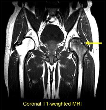 Bu görsel kalça kemiğini MRI Altında Femur Başı Avasküler Nekrozu durumunun olduğu bölgeye odaklanmaktadır. 