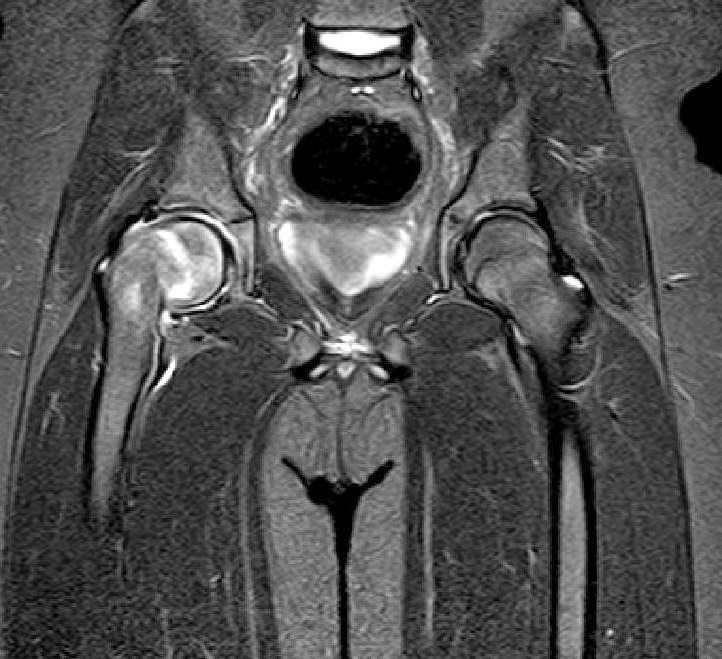 MRI Altında Femur Başı Epifiz Kayması'nın görüntülenmesi Opr. Dr. Halil Buldu.