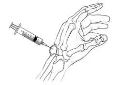 A scientific illustration showing exactly where the needle is inserted when treating a ganglion cyst - Op. Dr. Halil Buldu.
