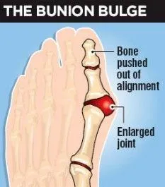 Illustration explaining hallux valgus on the foot from a scientific perspective, Op. Dr. Halil Buldu
