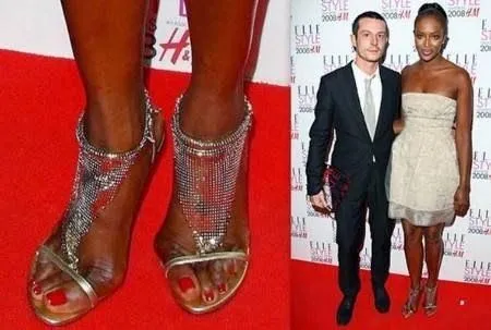 A photo showing hallux valgus, a deformity of the big toe, in real life on an artist. Op. Dr. Halil Buldu.