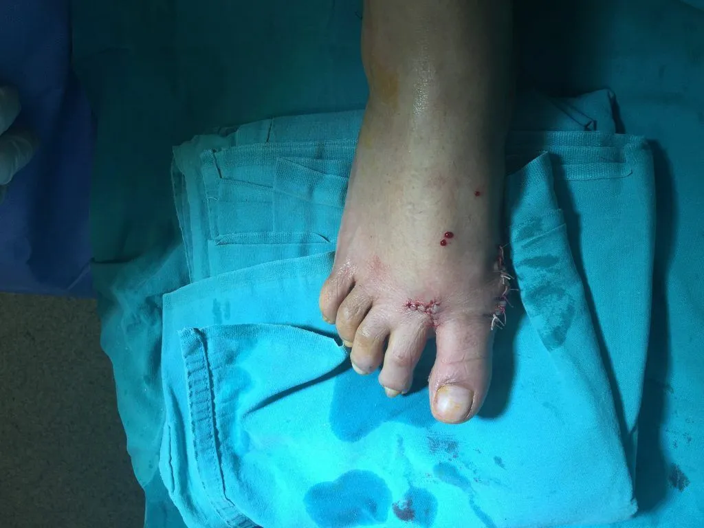 Hallux Valgus, Op. Dr. Halil Buldu