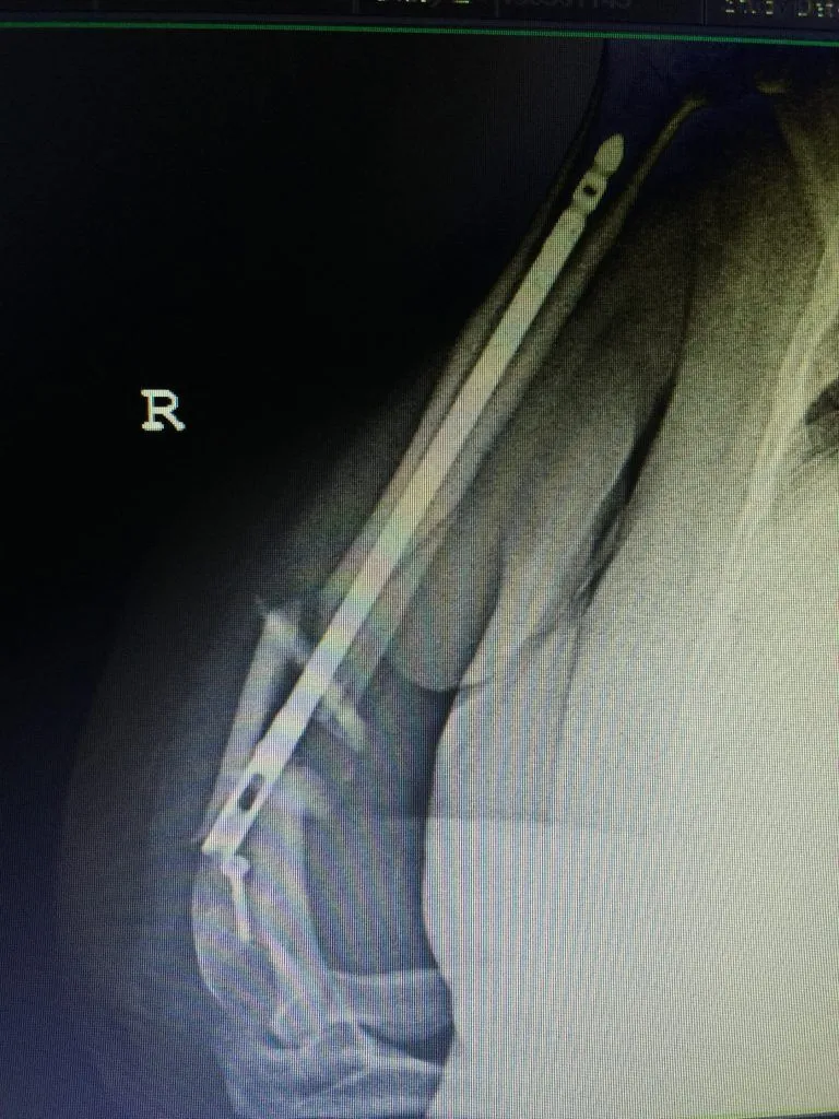 An image from one of the operations performed by Op. Dr. Halil Buldu for fracture nonunion. The connection between the bone and the attached device is visible on MRI.