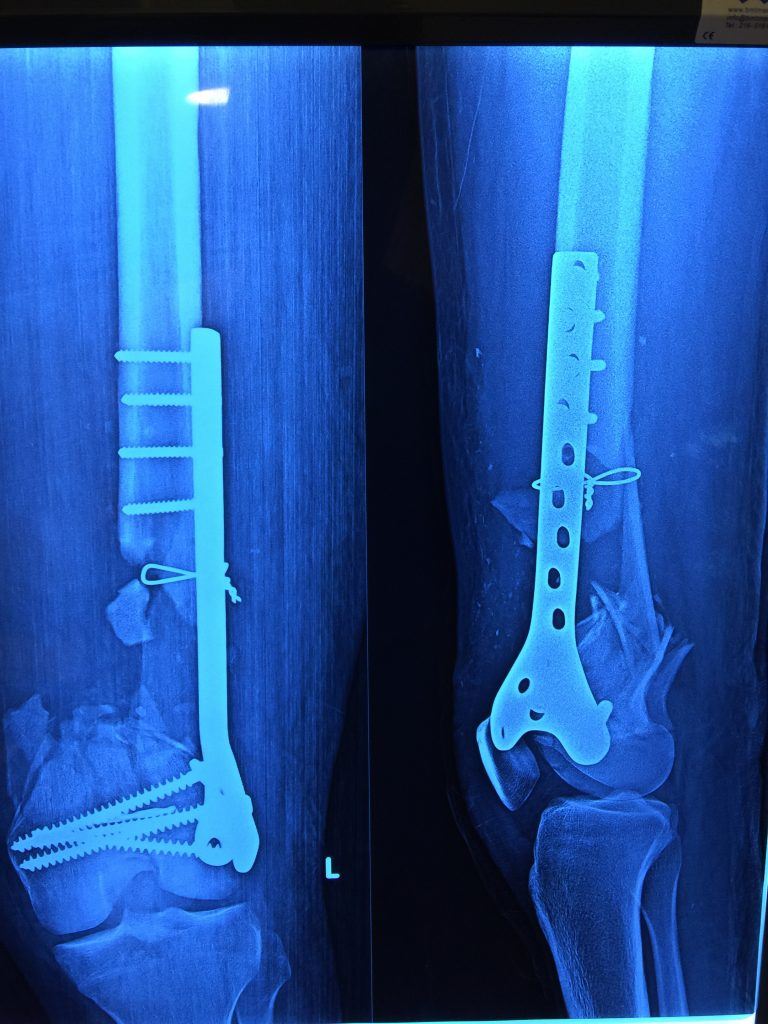Opr. Dr. Halil Buldu'nun kırık kaynamaması için yaptığı operasyondan bir görüntü. MR altında, kemikle cihazın bağlantısı gözüküyor.