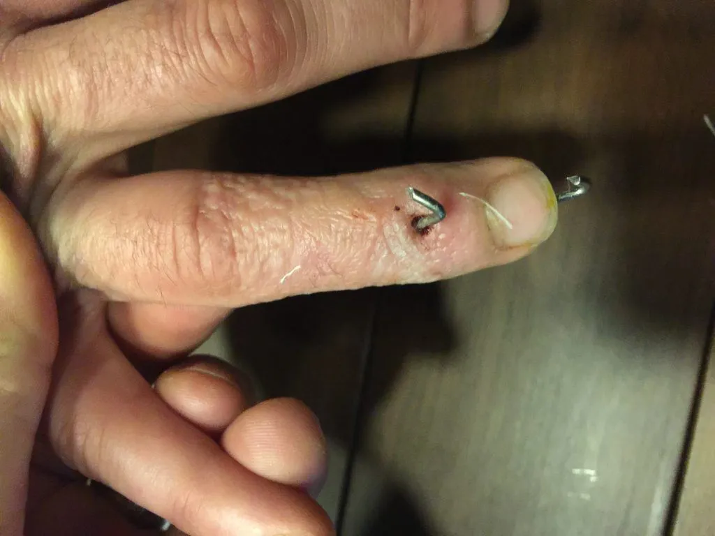 Mallet Finger (Hammer Finger), Op. Dr. Halil Buldu