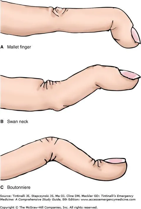 Illustration showing how mallet finger occurs, Op. Dr. Halil Buldu
