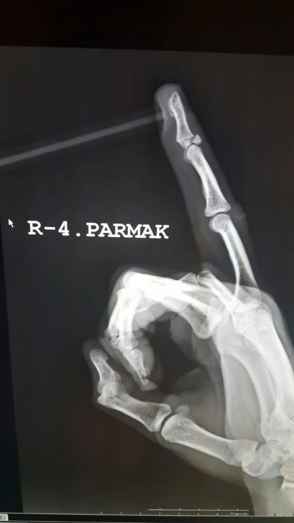Example of mallet finger on MRI, Op. Dr. Halil Buldu