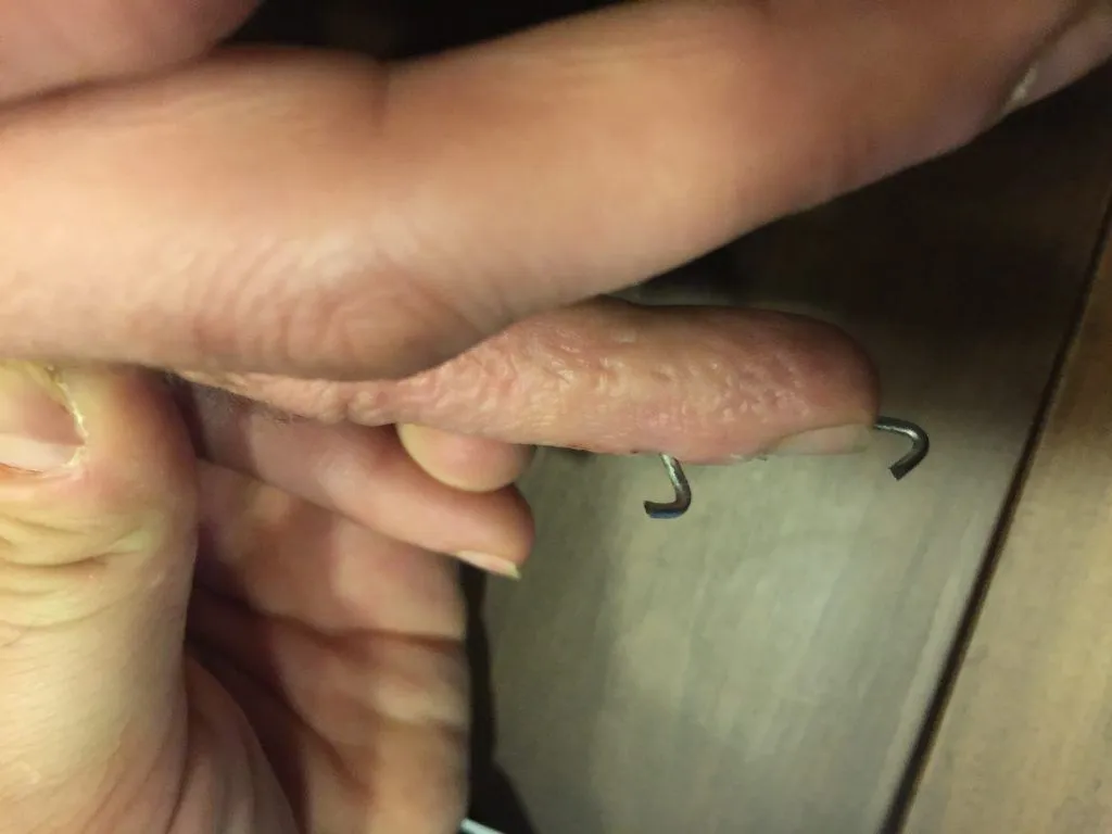 Mallet Finger (Hammer Finger), Op. Dr. Halil Buldu