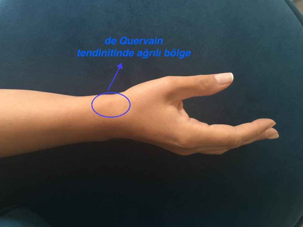 Opr. Dr. Halil Buldu'nun De Quervain Tenosinoviti operasyonu sonrasında oluşan gelişmeyi gösteren bir bandajlı el resmi.