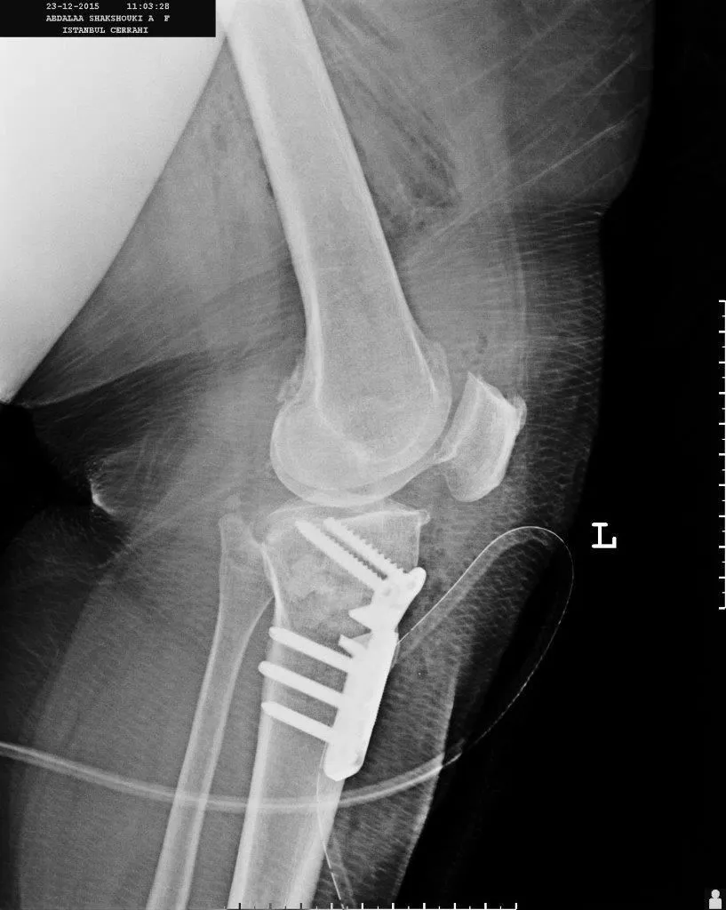X-ray images of leg curvature treatment