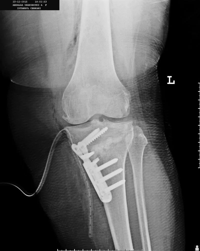 X-ray image of leg curvature treatment