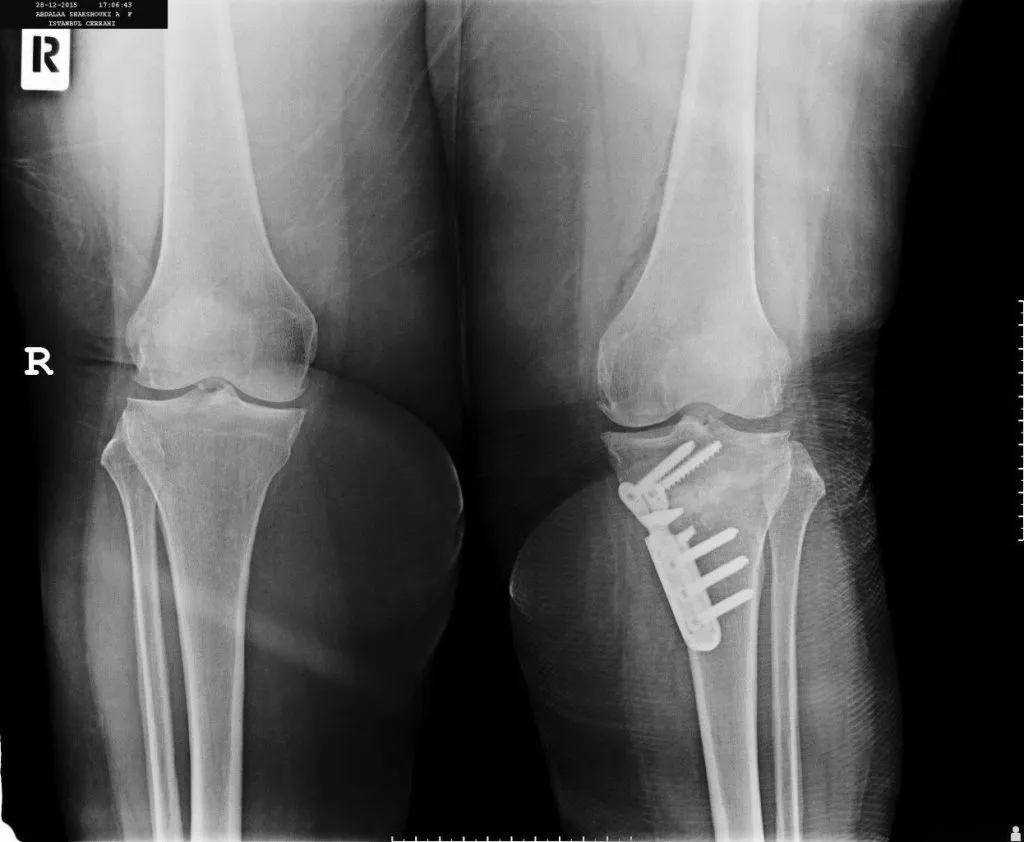 An X-ray image showing the treatment