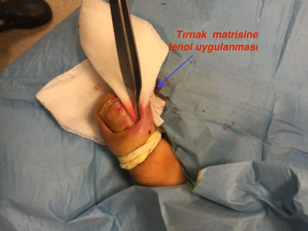 Applying phenol to the nail matrix