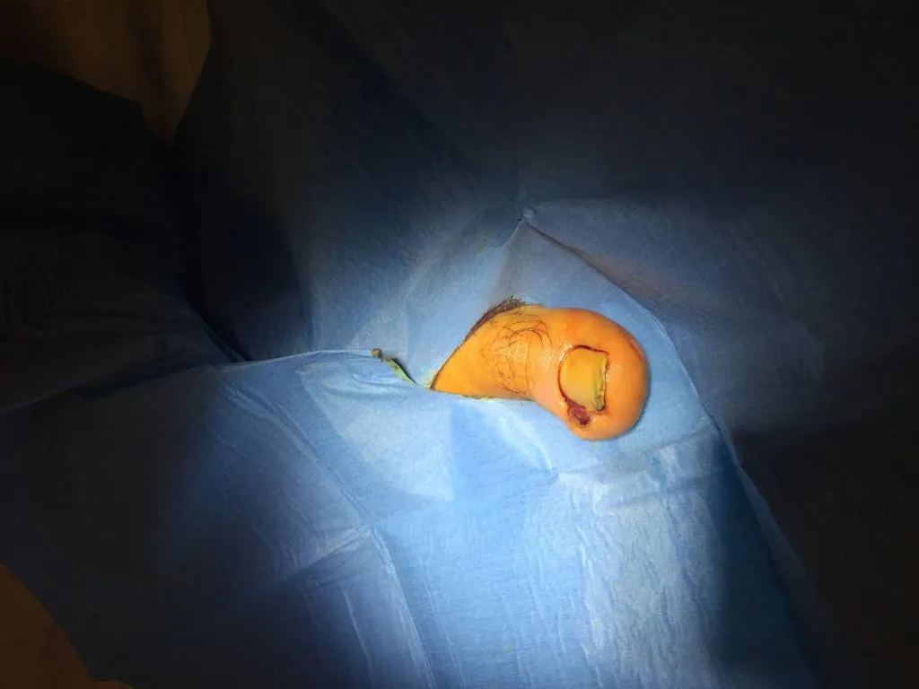 Ingrown toenail treatment: before surgery