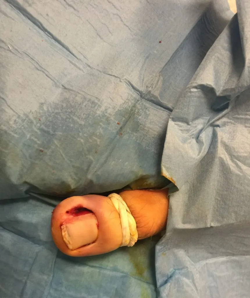 Surgical treatment of an ingrown toenail