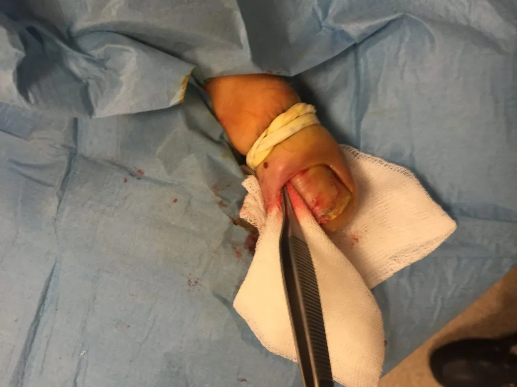 Surgical treatment of an ingrown toenail