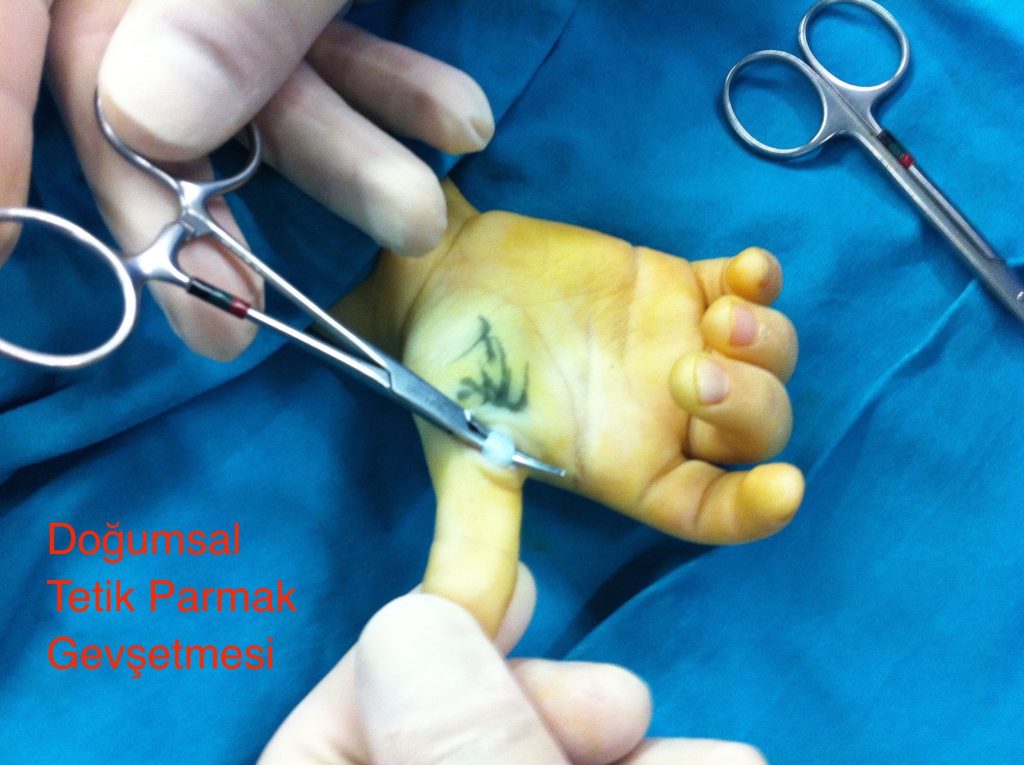 Tetik Parmak Tedavisi - Doğumsal Tetik Parmak Gevşetmesinin nasıl yapıldığını anlatan ameliyattan çekilmiş bir fotoğraf. Opr. Dr. Halil Buldu