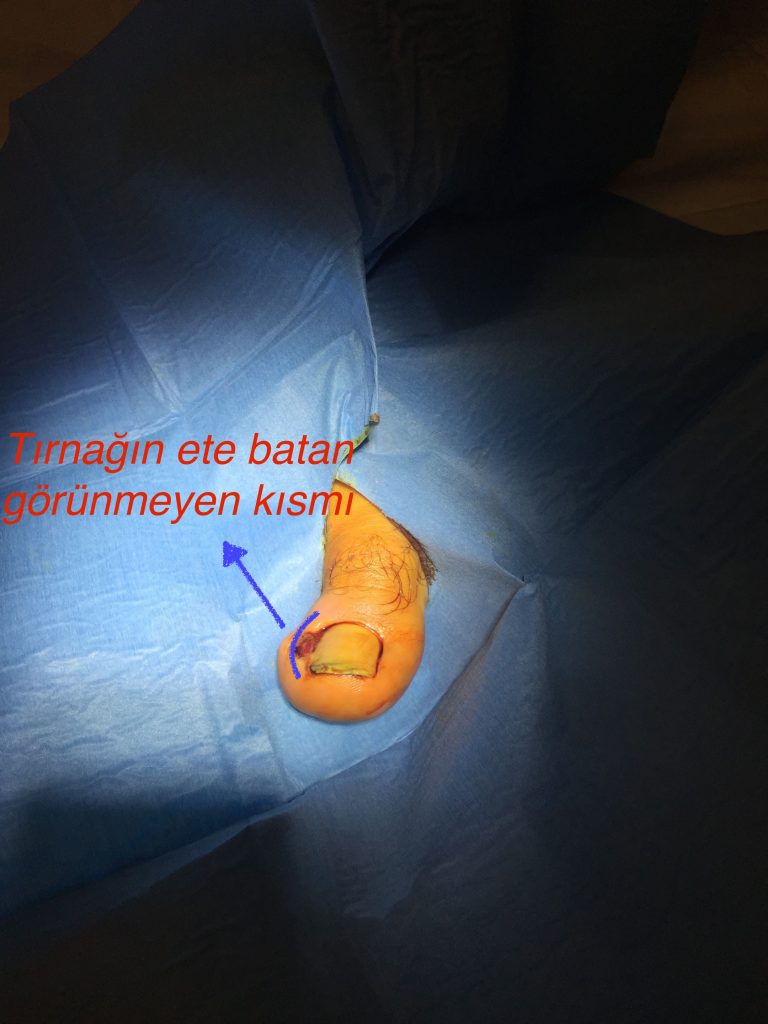 Tırnak Batma tedavisi, Tırnağın ete batan görünmeyen kısmının görseli Opr. Dr. Halil Buldu