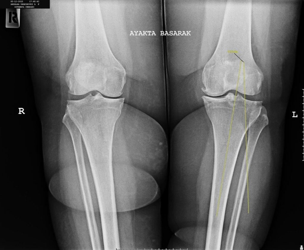 Yüksek Tibial Osteotomi'nin açısını X ray altında çekilmiş bir fotoğrafı - Opr Dr Halil Buldu