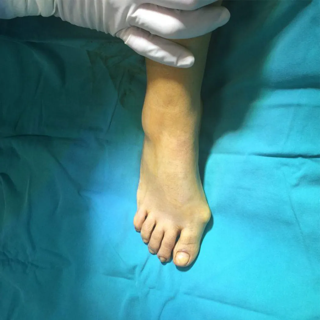 Halluks Valgus Tedavisi