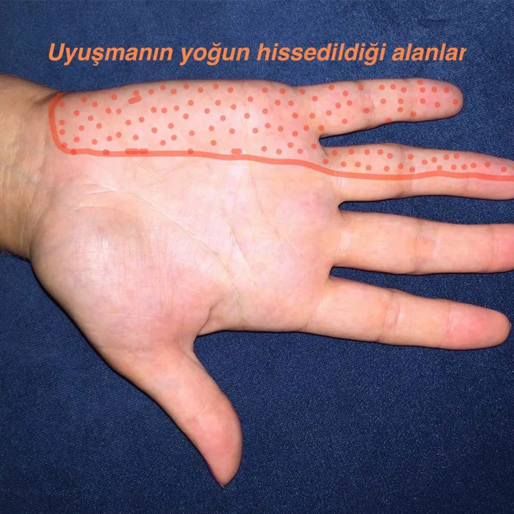 Kubital Tünel Sendromu Tedavisi