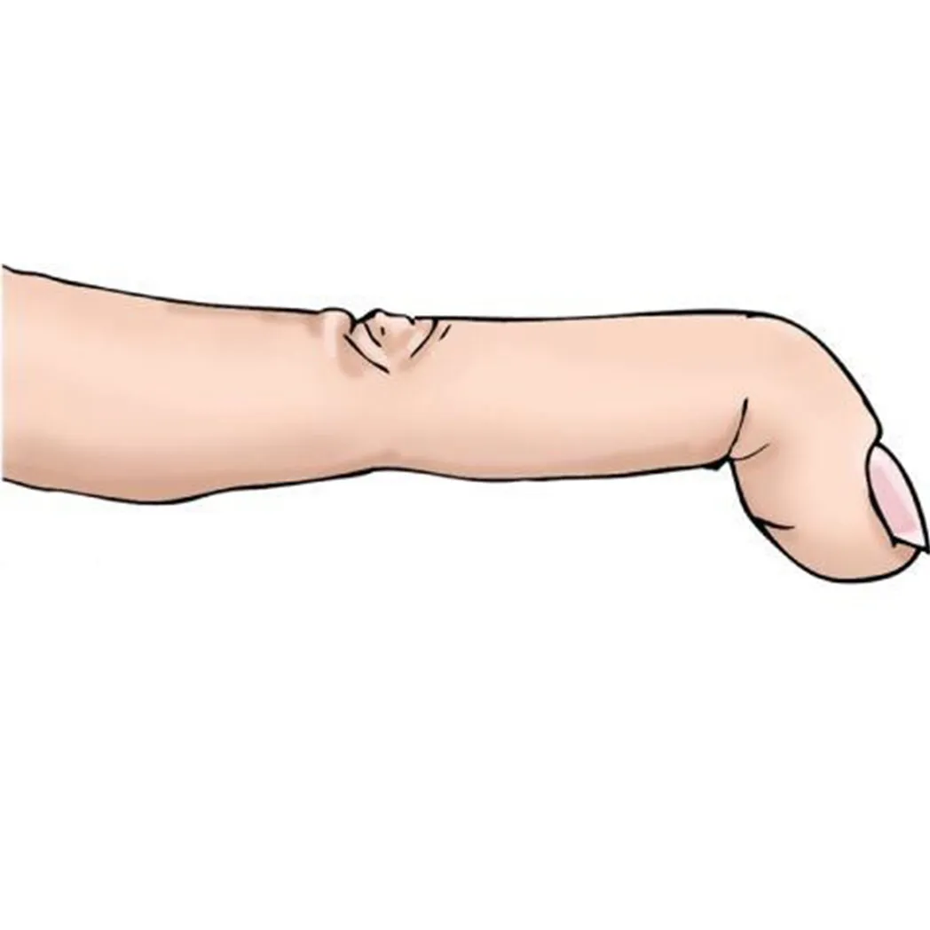 Çekiç Parmak (Mallet Finger) Tedavisi
