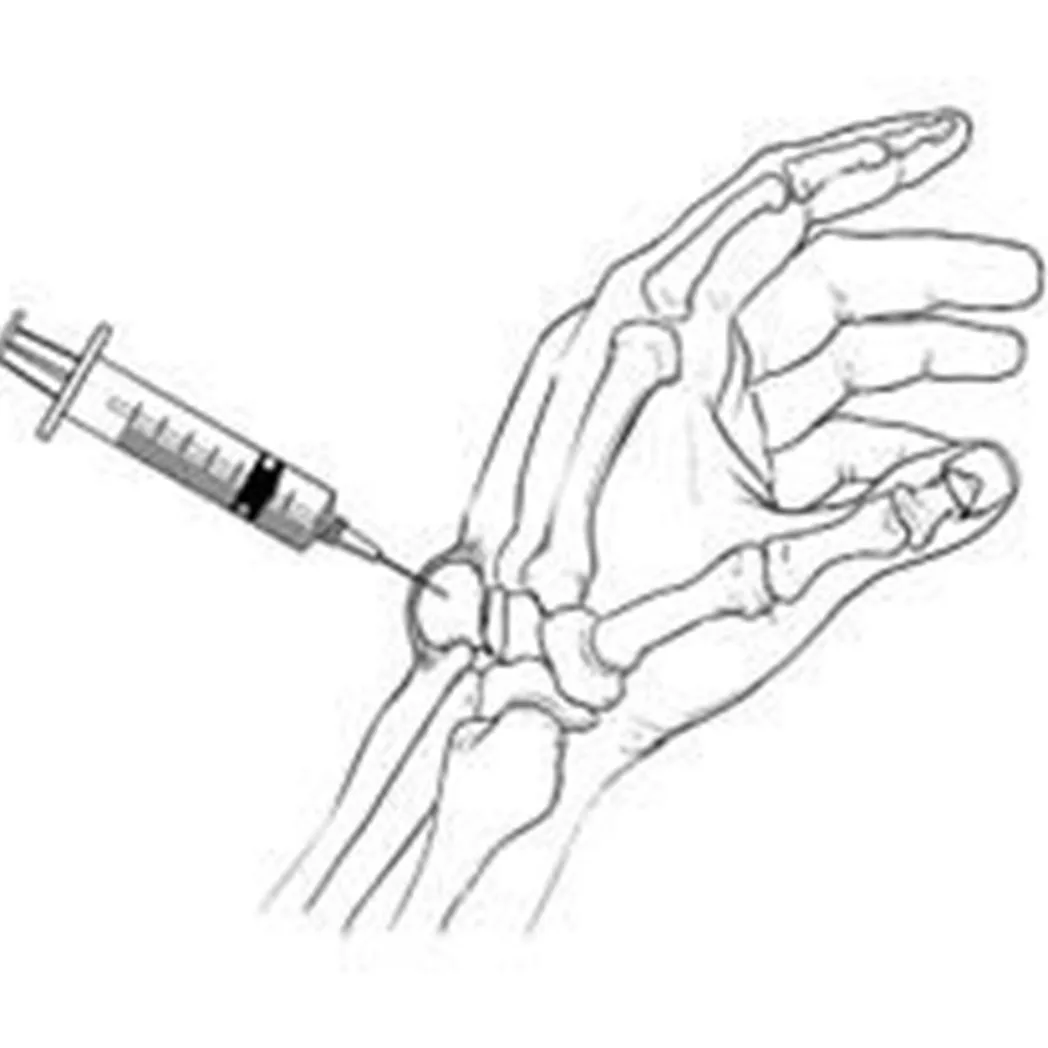 Ganglion Kisti Tedavisi