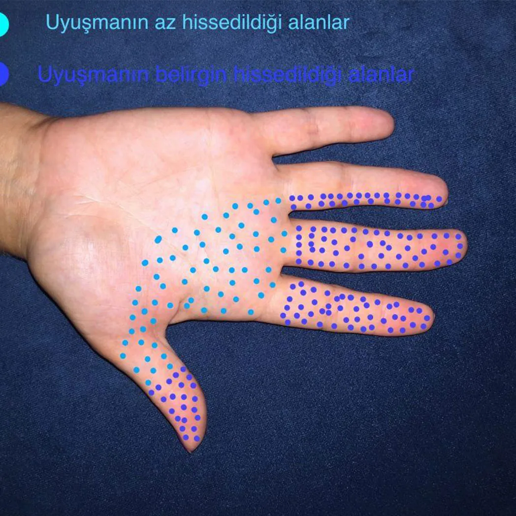 Karpal Tünel Sendromu Tedavisi